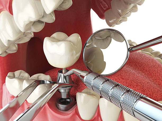 Best Broken or Chipped Tooth Repair in Lowell, IN